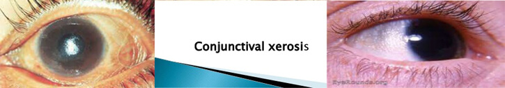conjunctival xerosis