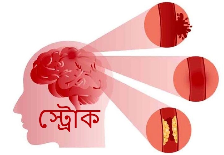 স্ট্রোকের লক্ষণ