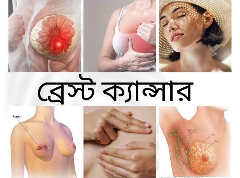 ব্রেস্ট ক্যান্সার